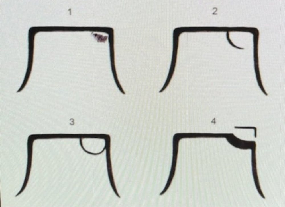 Οστεοχόνδρινες βλάβες αστραγάλου σε αθλητές, του Νίκου Δεσποτάκη runbeat.gr